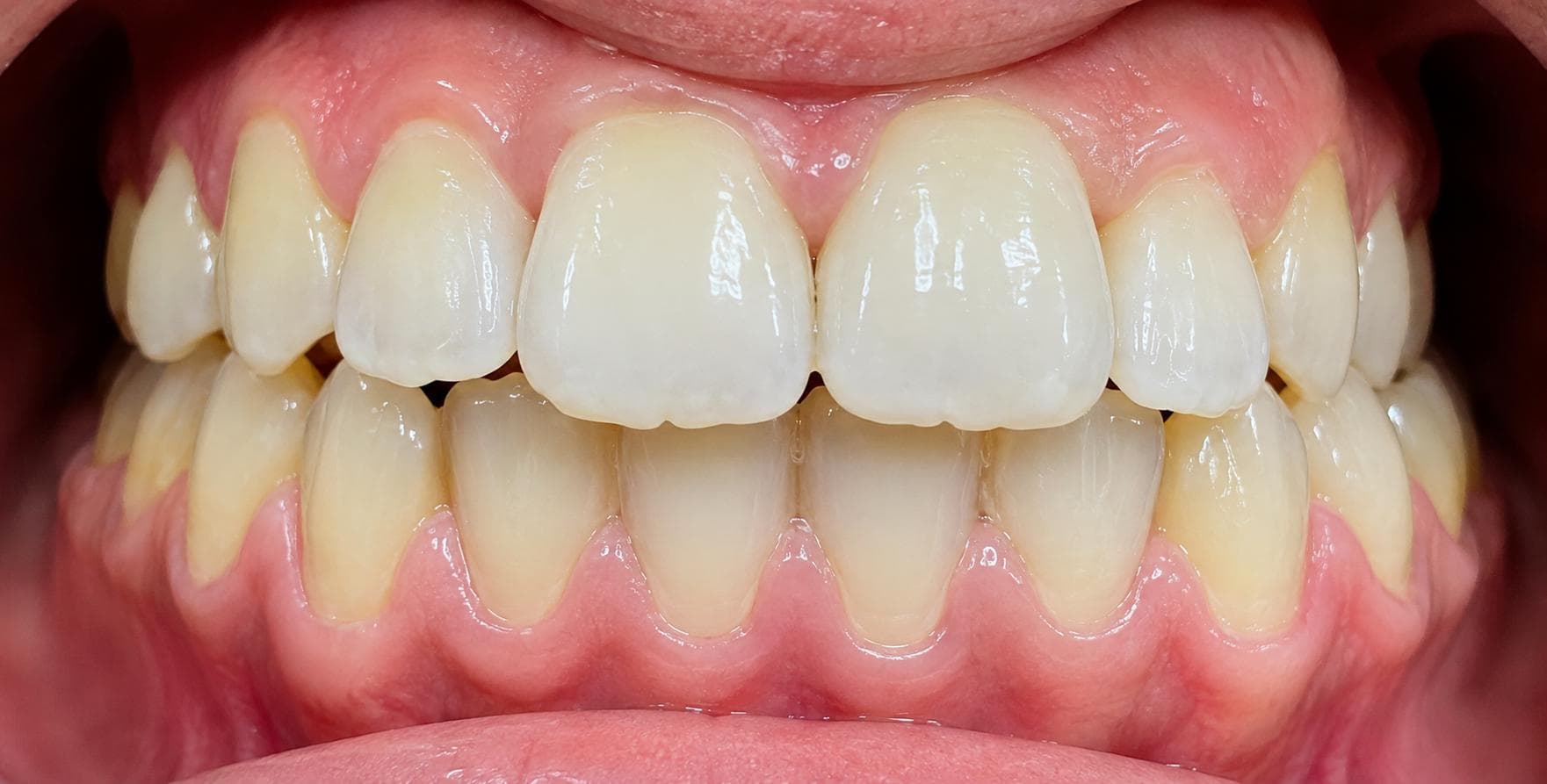 Aligners, after photo