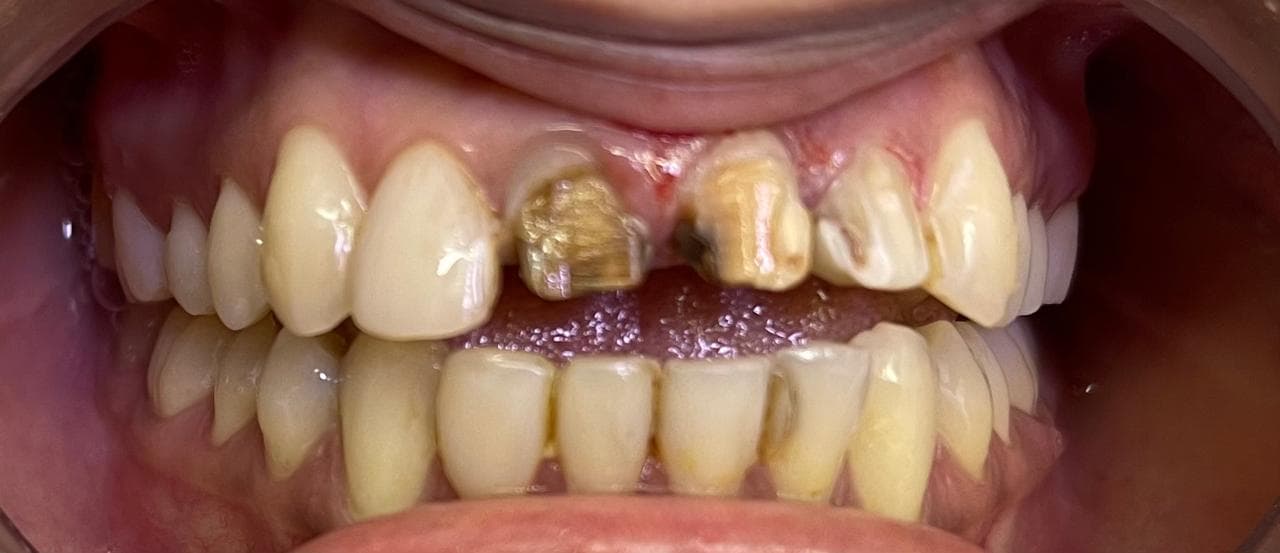 Crowns and Bridges, before photo
