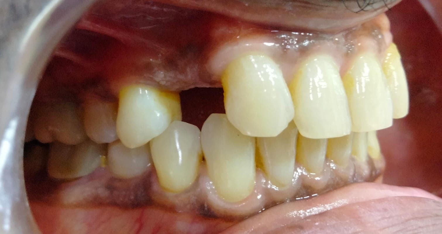 Dental Implant, before photo