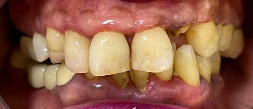 Full Mouth Rehabilitation, before photo