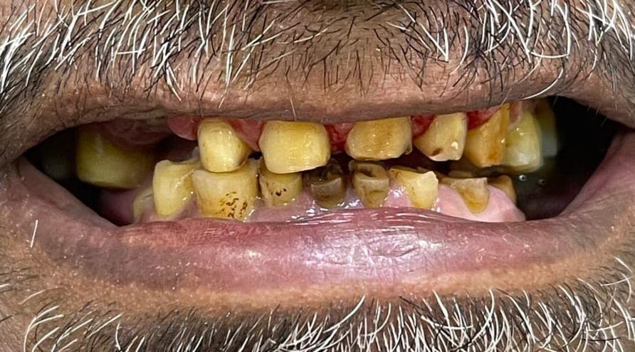 Full Mouth Rehabilitation, before photo