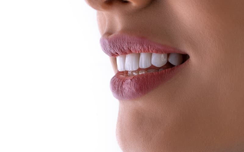 Teeth Whitening at Home vs Professional Clinic, What Works Better?