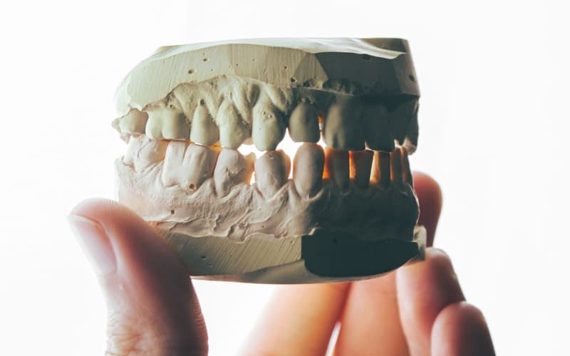 How Long Do Dental Implants Last? Realistic Expectations